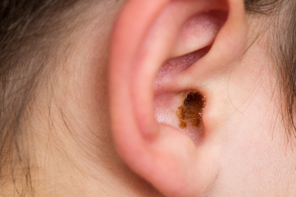 How to unblock ears full of wax with ear syringing - Orion Pharmacy