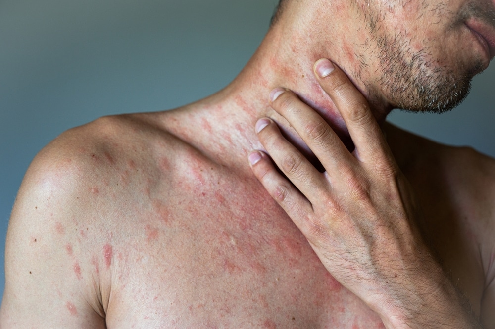 Orion Pharmacy's Guide to Chickenpox Vaccination for Men